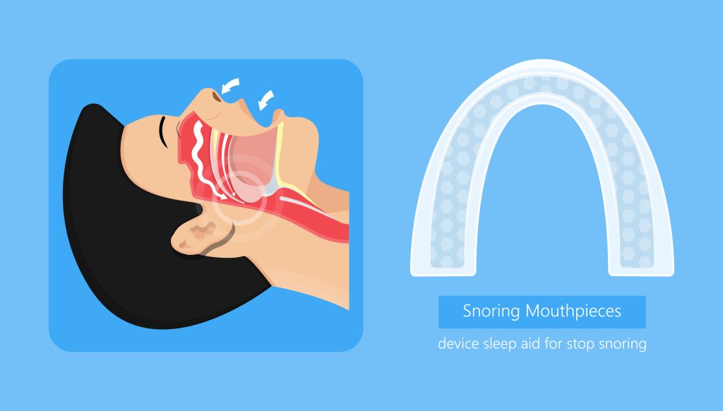 oral appliance image